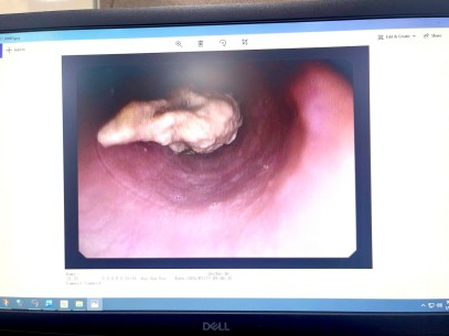 Dị vật (cục thịt) đường tiêu hoá  Cụ bà 78T 1